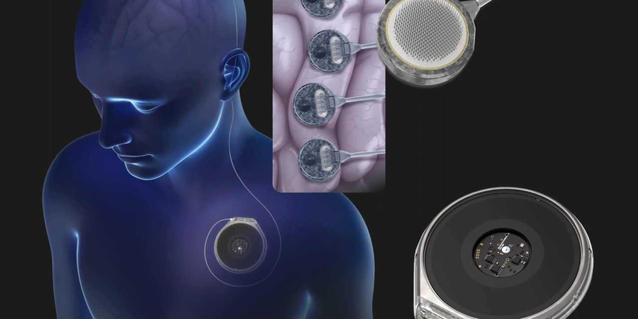 Paradromics gears up to test its brain implant on humans